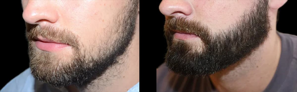 Beard hair transplant result