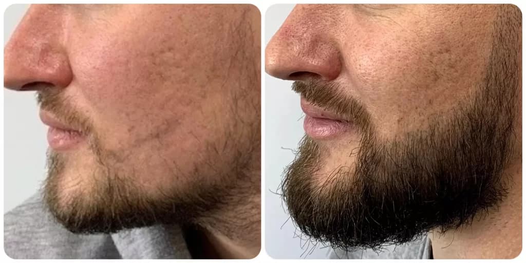 Beard hair transplant result