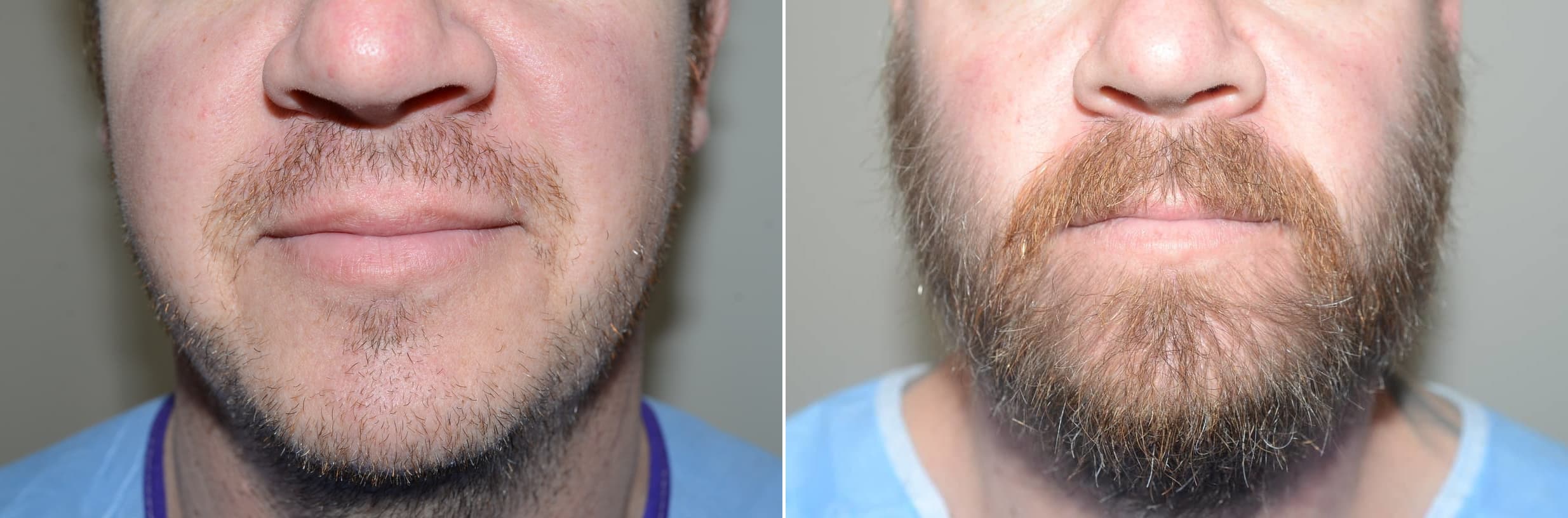 Beard hair transplant result