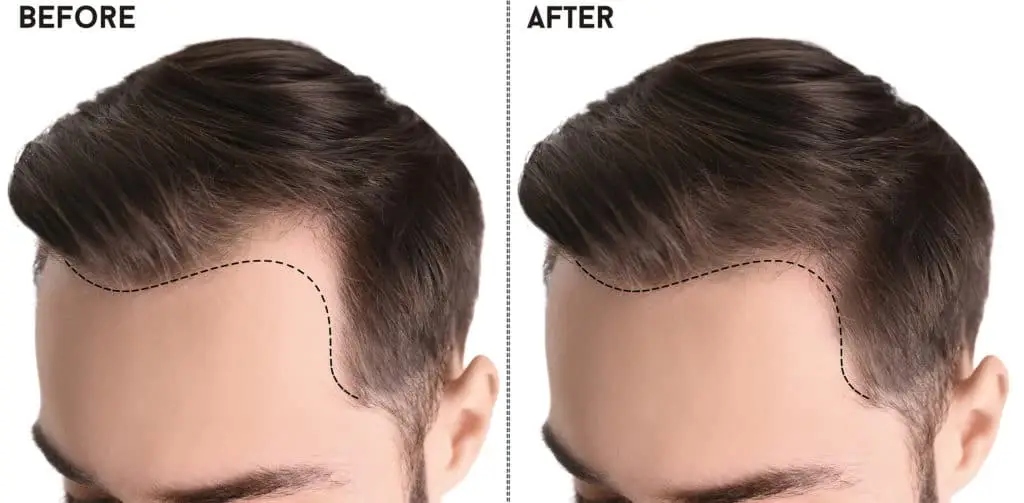 Plasma treatment consultation