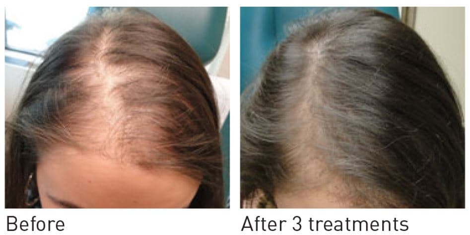 Plasma treatment aftercare session