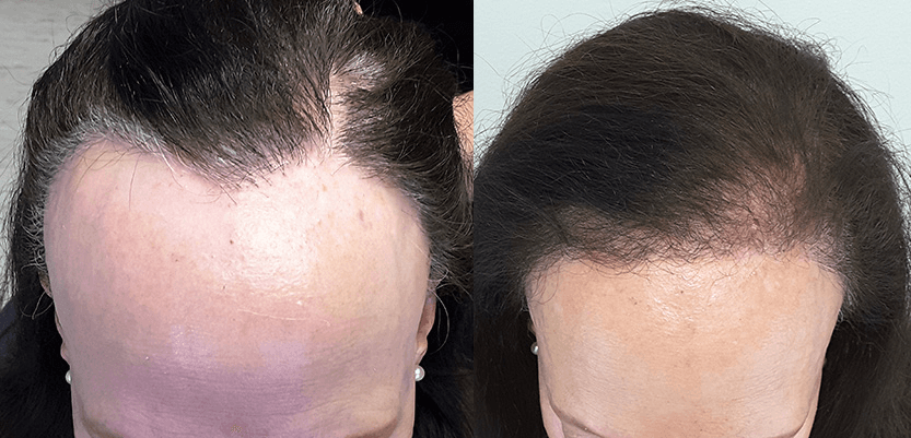Women hair transplant result
