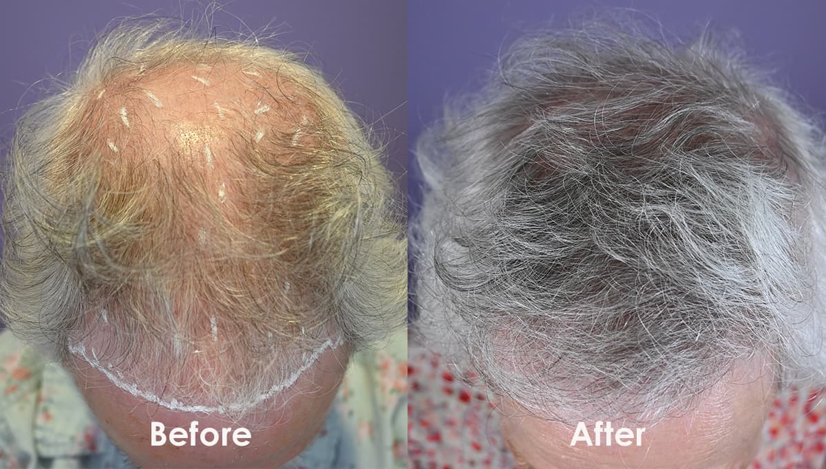 Women hair transplant result