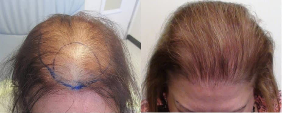 Women hair transplant result