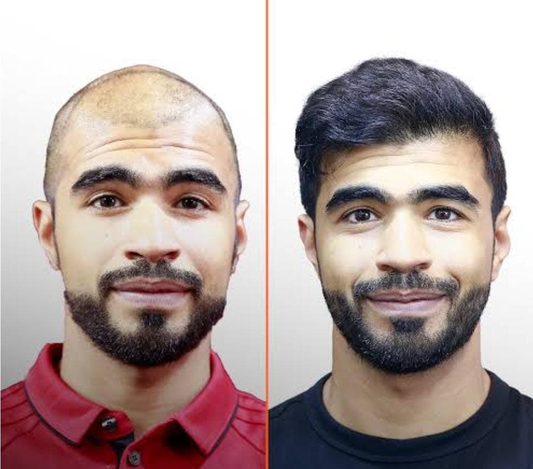 Before and after hair transplant
