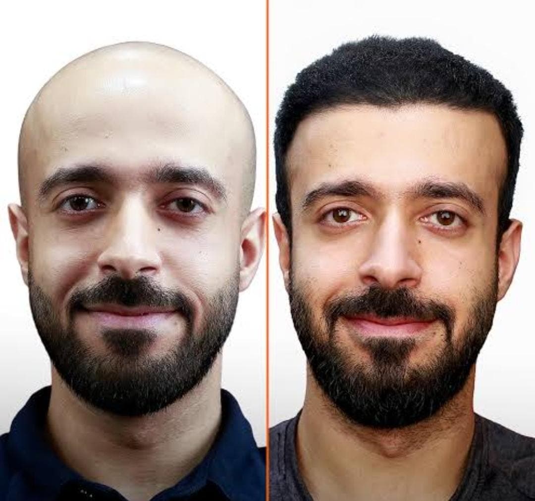 Before and after hair transplant
