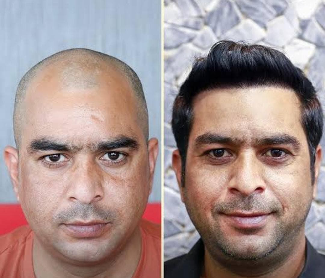 Before and after hair transplant