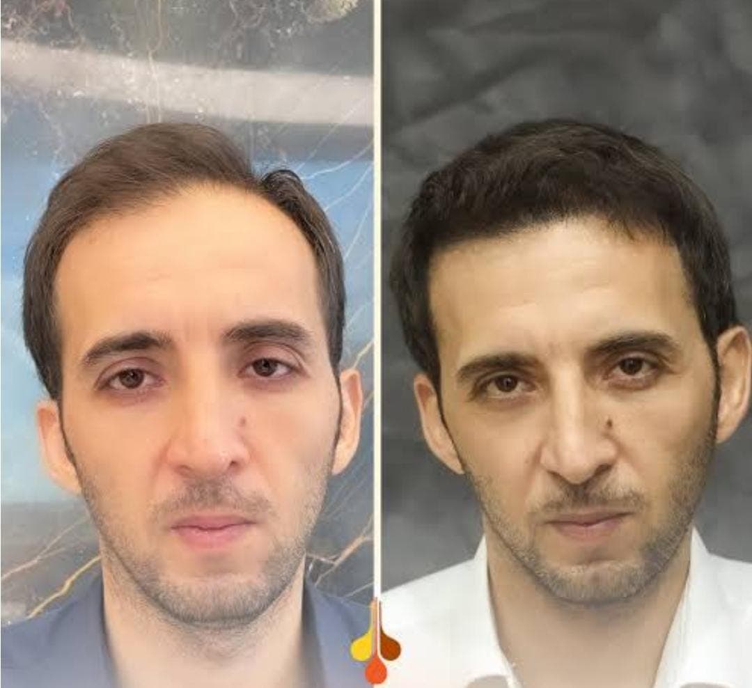 Before and after hair transplant