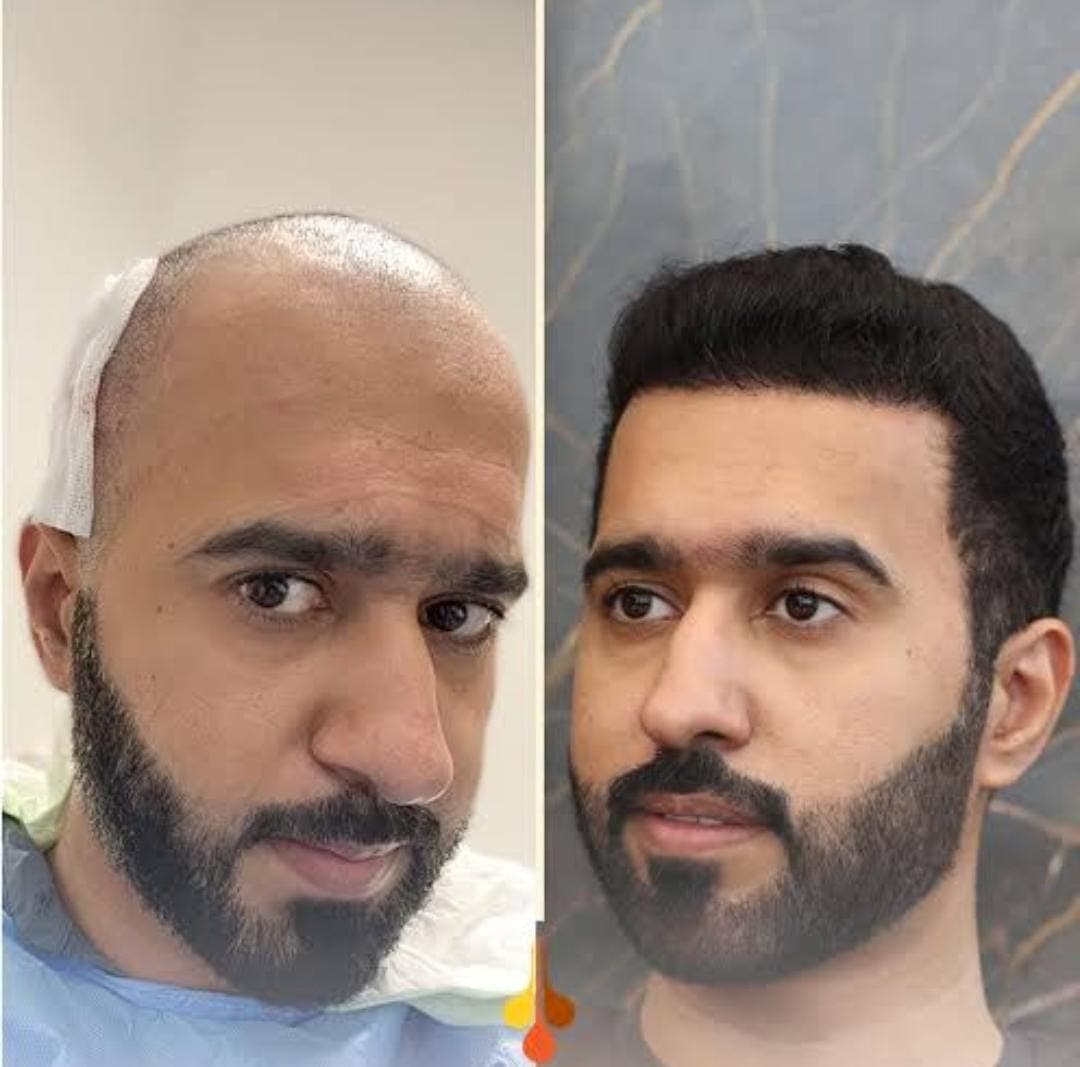 Before and after hair transplant