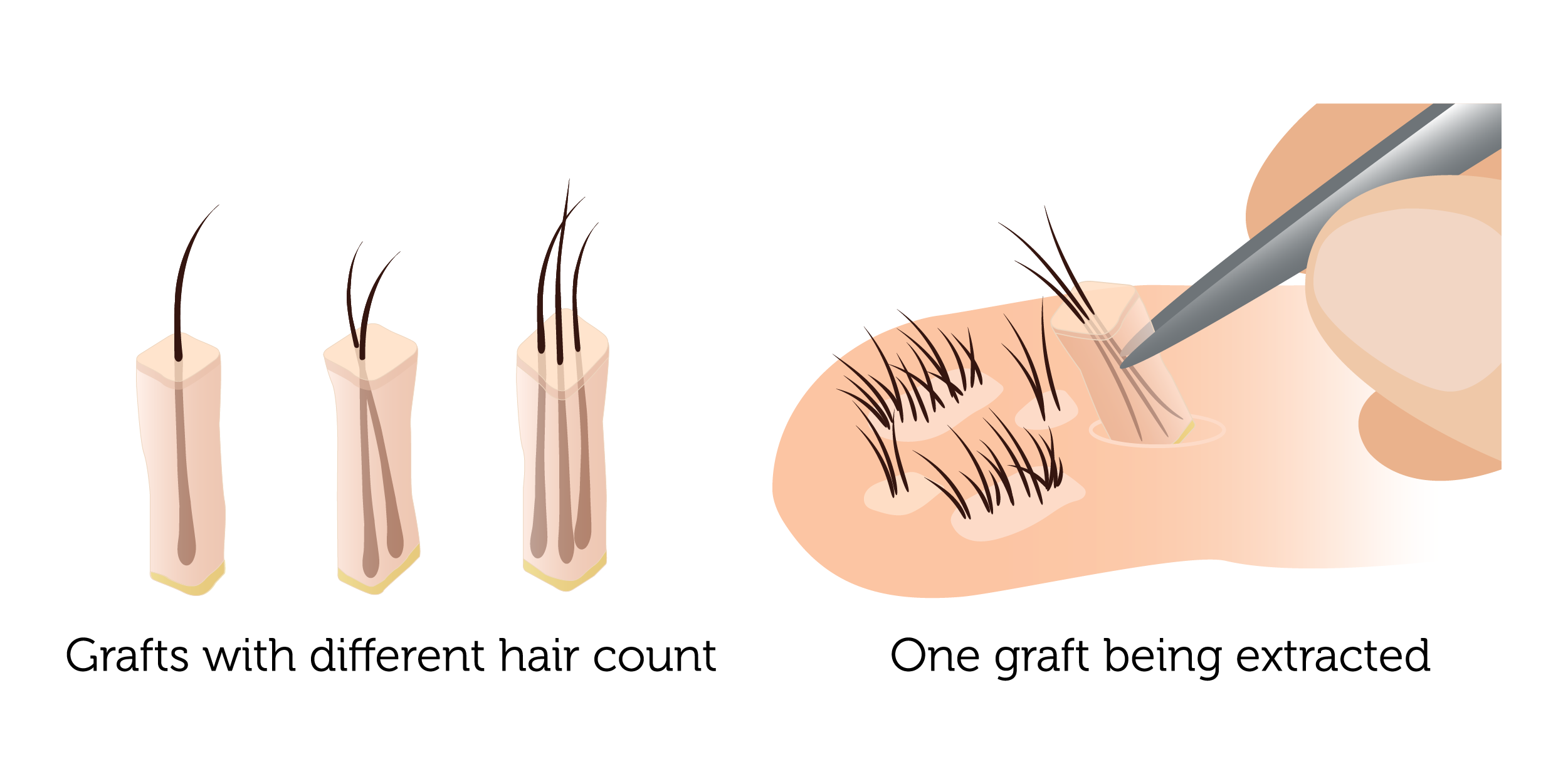 Harvesting grafts (FUE)