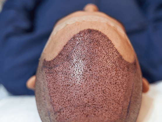 Immediate post-op review