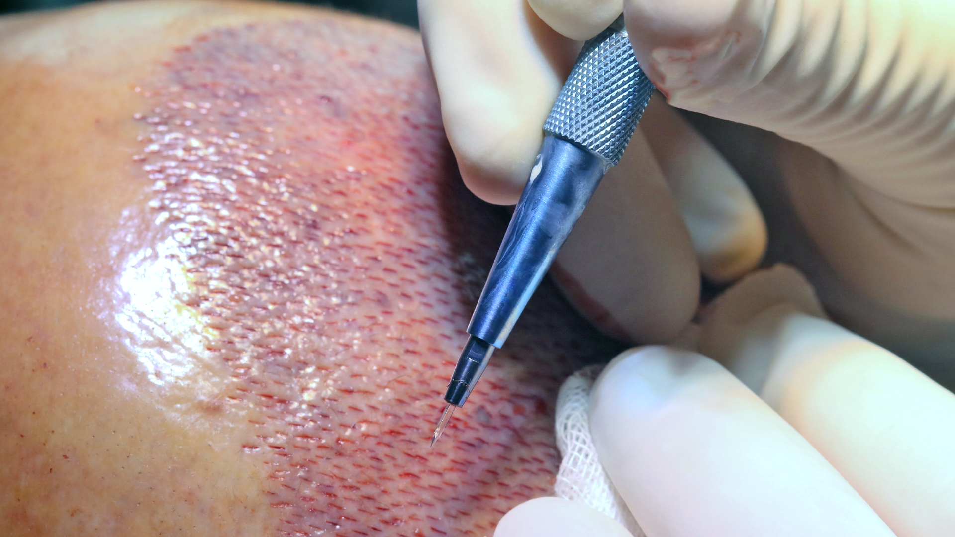Implantation with sapphire pin
