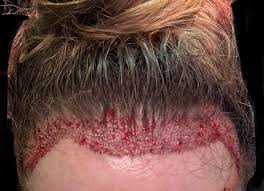 Contrôle post-op immédiat